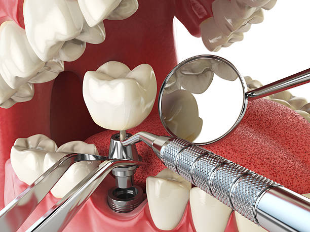 Best Emergency Tooth Extraction in Defuniak Springs, FL